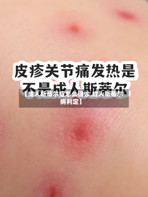【成人斯蒂尔症怎么确诊,成人斯蒂尔病判定】