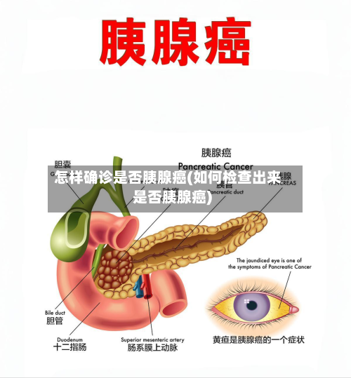 怎样确诊是否胰腺癌(如何检查出来是否胰腺癌)-第2张图片