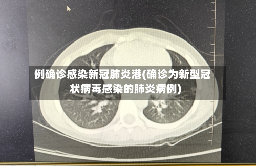 例确诊感染新冠肺炎港(确诊为新型冠状病毒感染的肺炎病例)