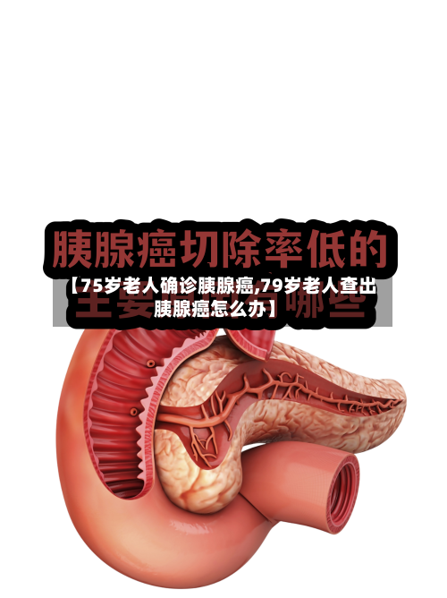 【75岁老人确诊胰腺癌,79岁老人查出胰腺癌怎么办】-第3张图片