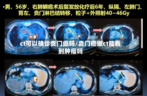 ct可以确诊贲门癌吗/贲门癌做ct能看到肿瘤吗