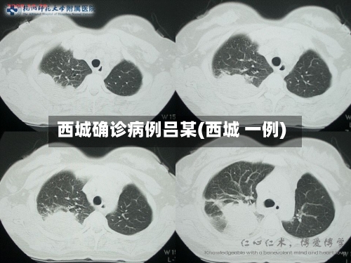 西城确诊病例吕某(西城 一例)