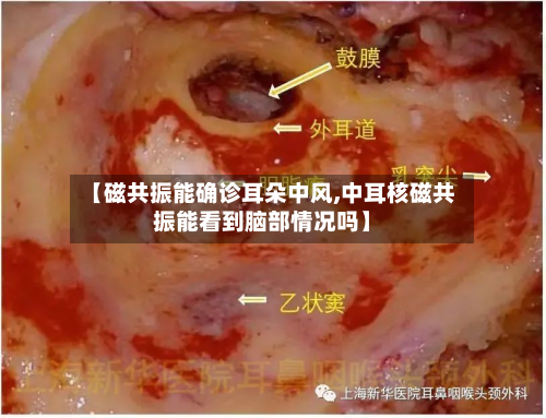 【磁共振能确诊耳朵中风,中耳核磁共振能看到脑部情况吗】