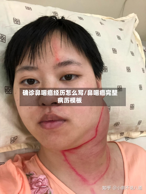 确诊鼻咽癌经历怎么写/鼻咽癌完整病历模板