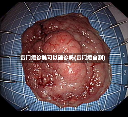 贲门癌诊脉可以确诊吗(贲门癌自测)