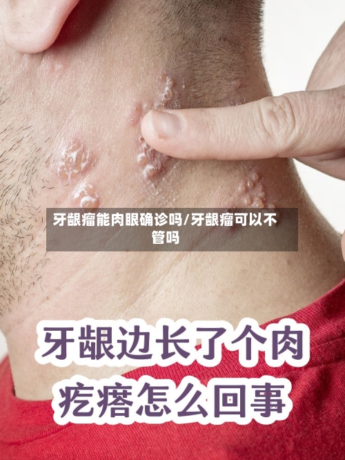 牙龈瘤能肉眼确诊吗/牙龈瘤可以不管吗-第2张图片
